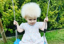 Síndrome de cabello impeinable: La familia de una niña busca concientizar sobre su situación Impeinable