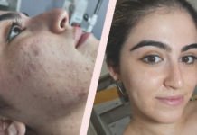 ¿De qué manera se puede cuidar la piel y tratar los acnés y rosáceas? Piel