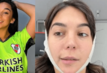 Luciana Milessi sufre de parálisis facial luego de múltiples cirugías estéticas