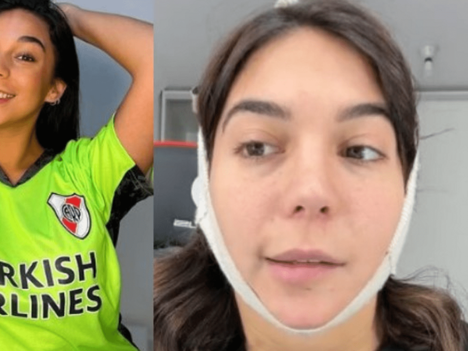Luciana Milessi sufre de parálisis facial luego de múltiples cirugías estéticas